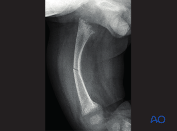 fractures in abnormal bone