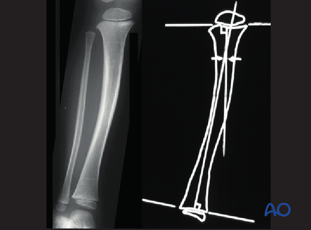 posttraumatic growth disturbance