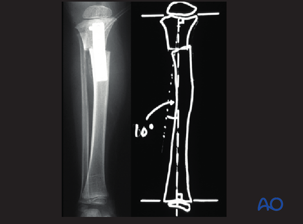 posttraumatic growth disturbance