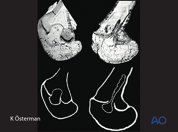 posttraumatic growth disturbance