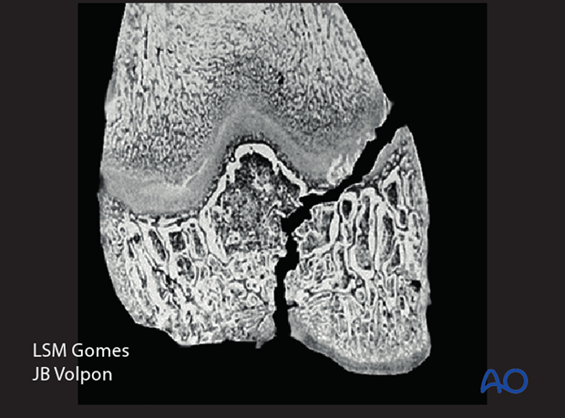 posttraumatic growth disturbance