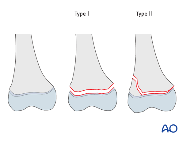 the physis