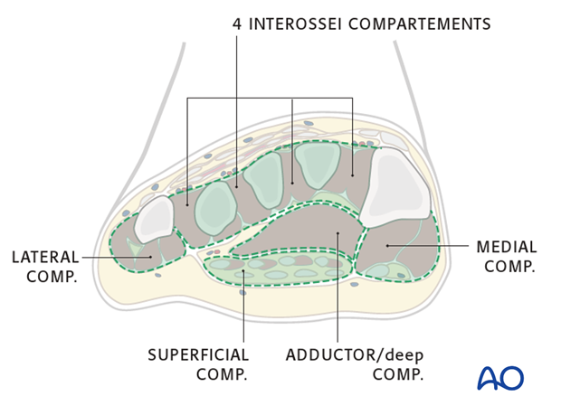 compartment syndrome