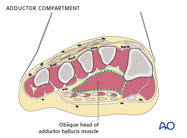 compartment syndrome