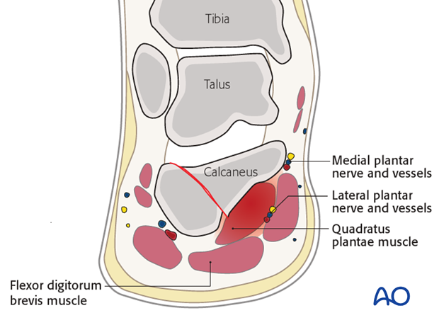 compartment syndrome