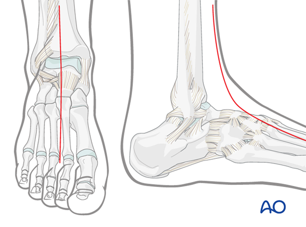 compartment syndrome