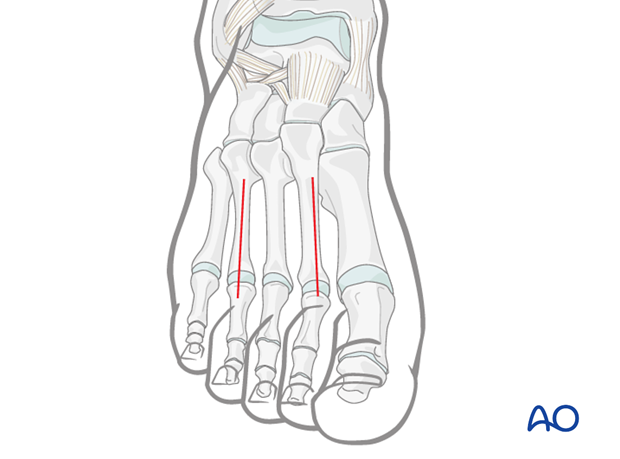 compartment syndrome