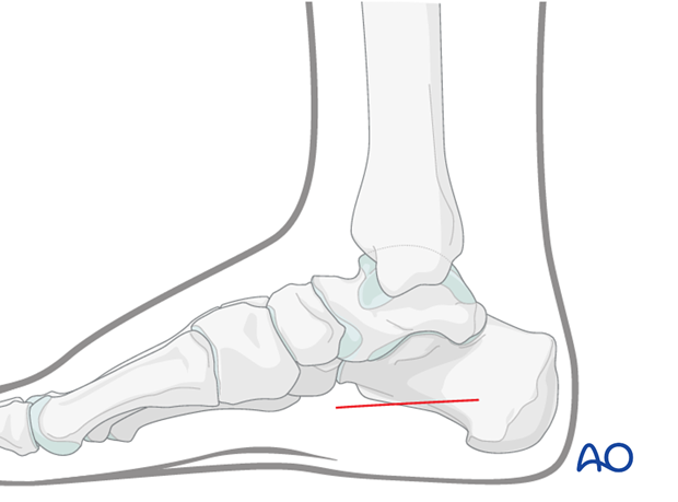 compartment syndrome