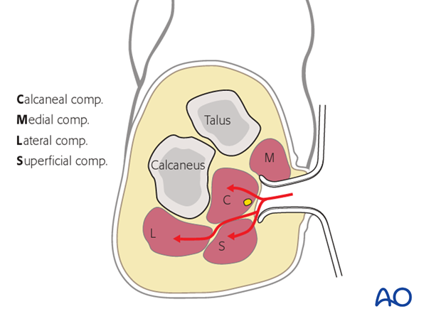 compartment syndrome