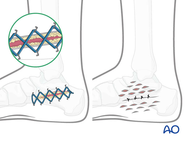 compartment syndrome