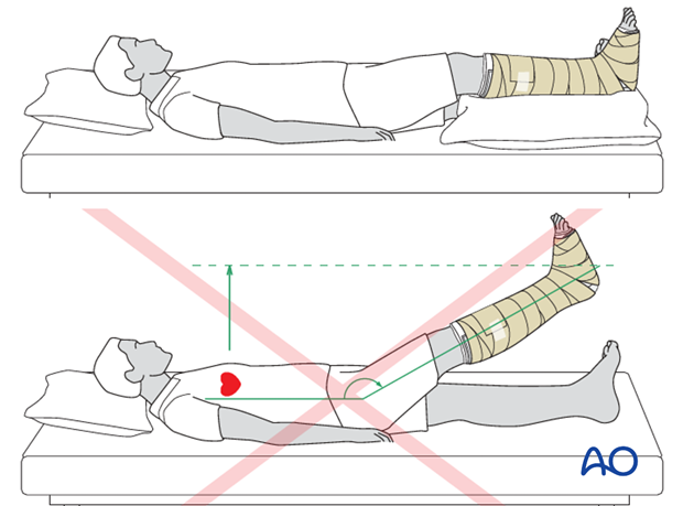 compartment syndrome