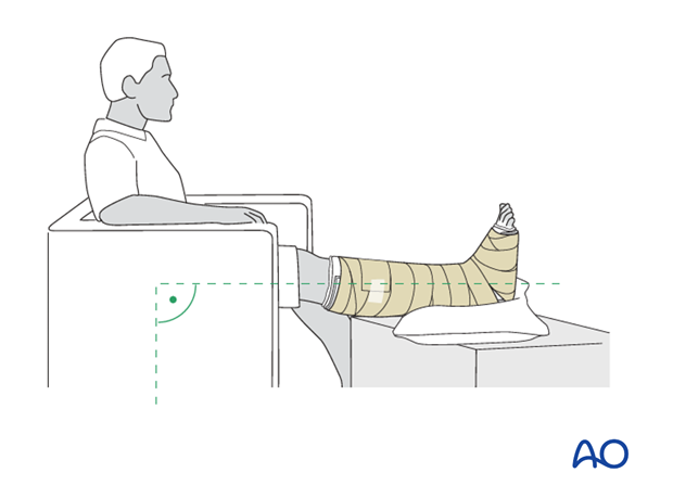 compartment syndrome