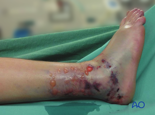 compartment syndrome