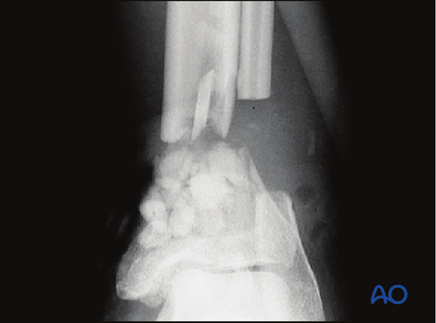 Recurrent osteomyelitis