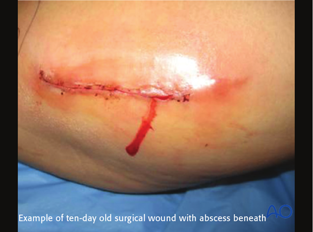 classifications of wound infection