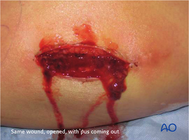 classifications of wound infection