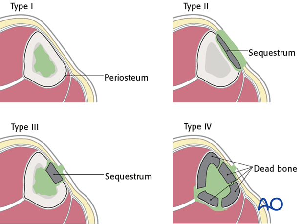 Cierny has classified fracture site infections according to a number of criteria.