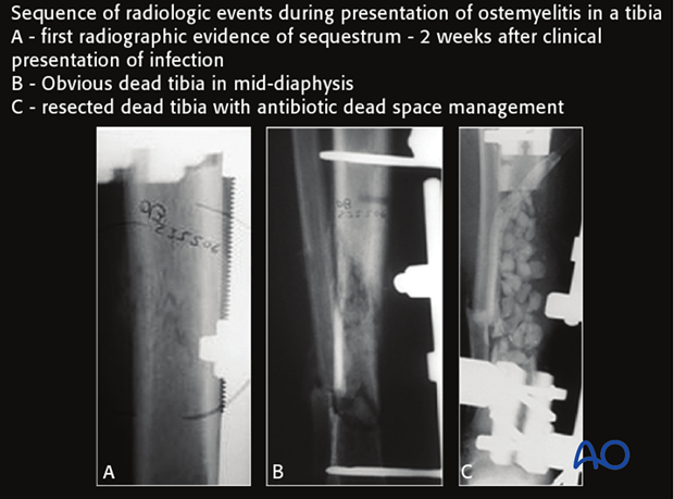 In the diagnosis of early infections, x-ray imaging plays a negligible role.