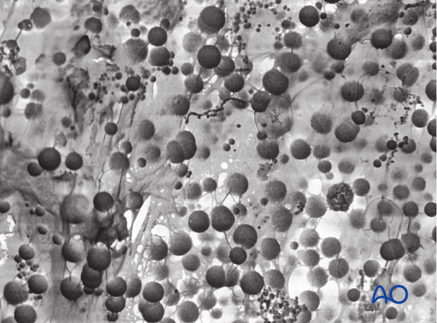 Many of the bacteria that inhabit chronic wounds set up complex polymicrobial biofilm communities