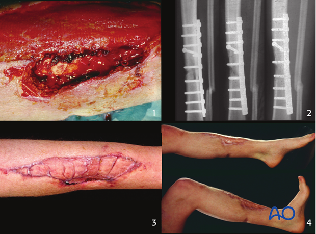 If an identified infection is treated early, and its fixation remains stable, then with appropriate surgical clearance...