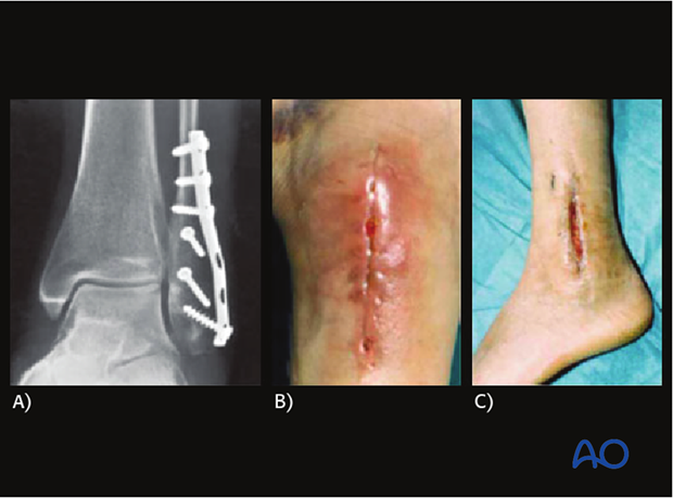 Following infection after ORIF (A, B) and after débridement has been satisfactorily completed, in one or more procedures (C),...