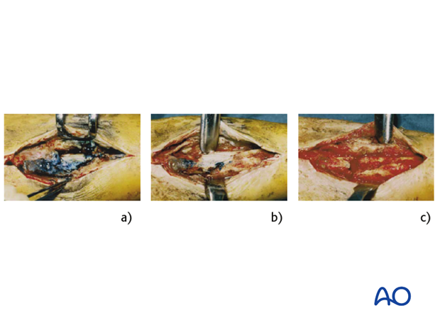 A “second look” and possibly further débridement should be undertaken, until the wound surface is completely viable...