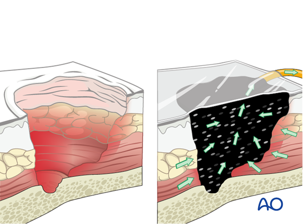 After the first surgical clearance of an infected fracture wound, it is essential to defer suture closure...