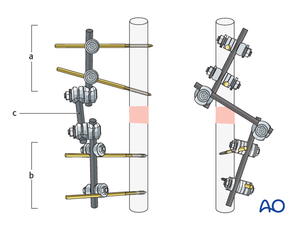 basic technique modular external fixation