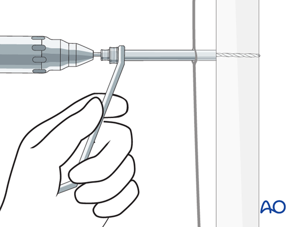 basic technique modular external fixation