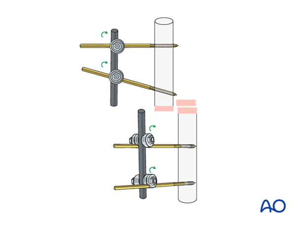 basic technique modular external fixation