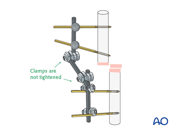 basic technique modular external fixation