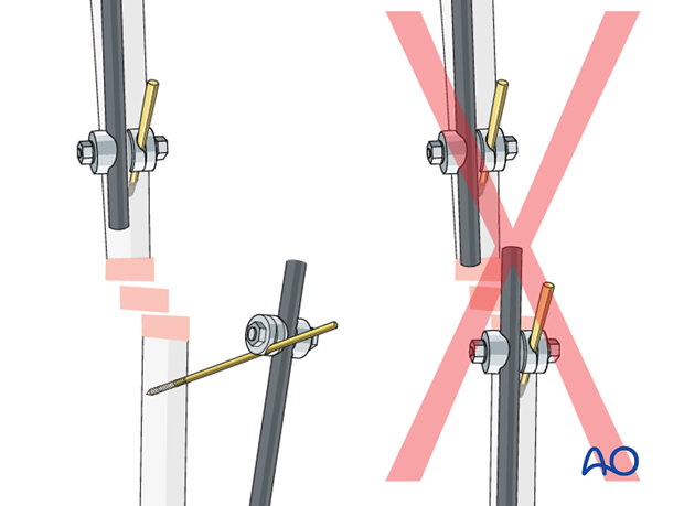 basic technique modular external fixation