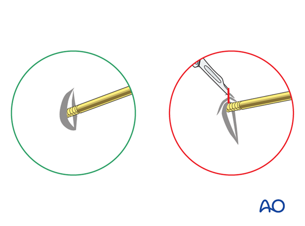 basic technique modular external fixation