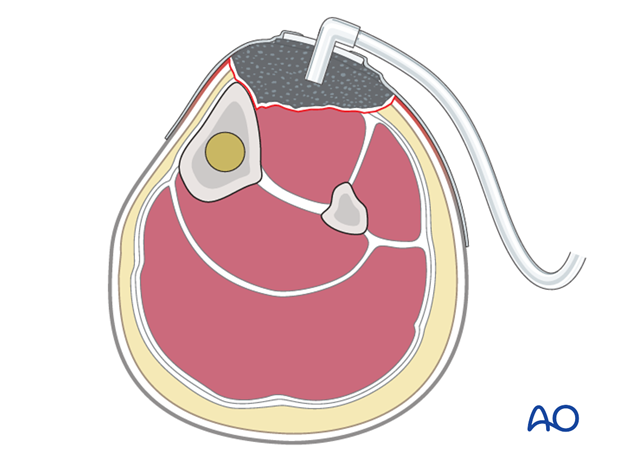 Any open wound needs to be protected from secondary contamination.