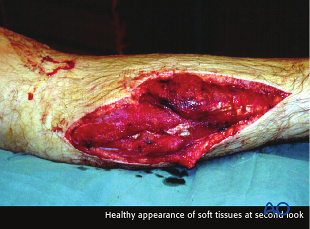 principles of management of open fractures