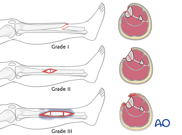 This illustration summarizes the three basic grades – I, II & III