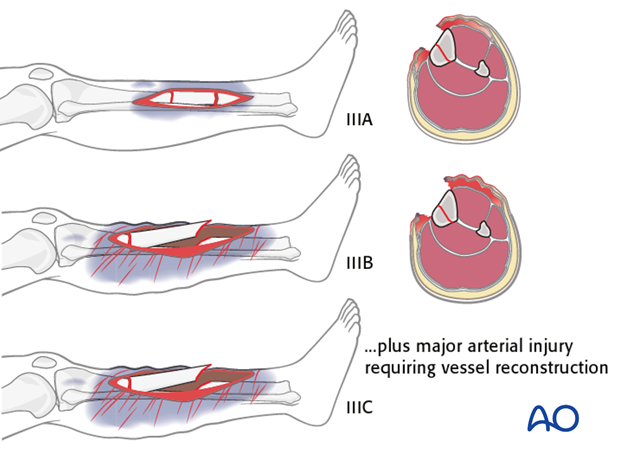 These examples illustrate the three types IIIA, IIIB & IIIC