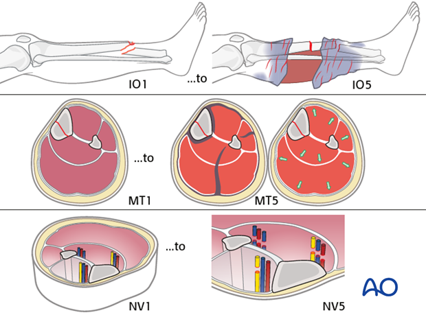 The AO classification of fracture wound severity provides a grading system for injuries of each of the skin (I),...