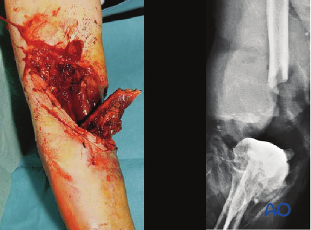 Principles of management of open fractures