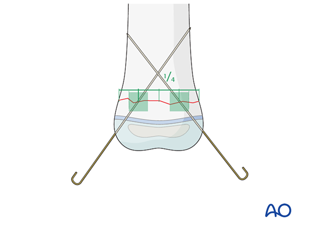 K-wire direction in transverse fractures