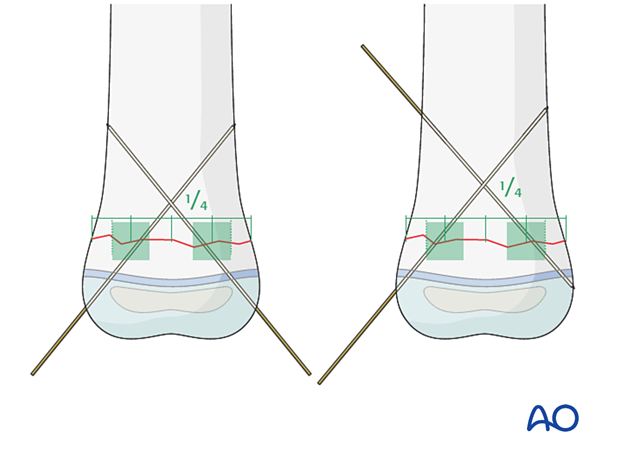 K-wire construct for stabilization of a metaphyseal fracture