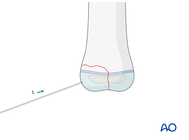 Orthogonal initial K-wire insertion