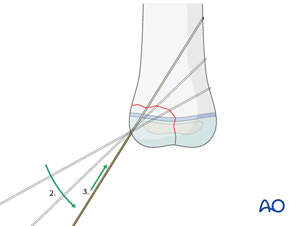 Adjusting angulation of K-wire direction