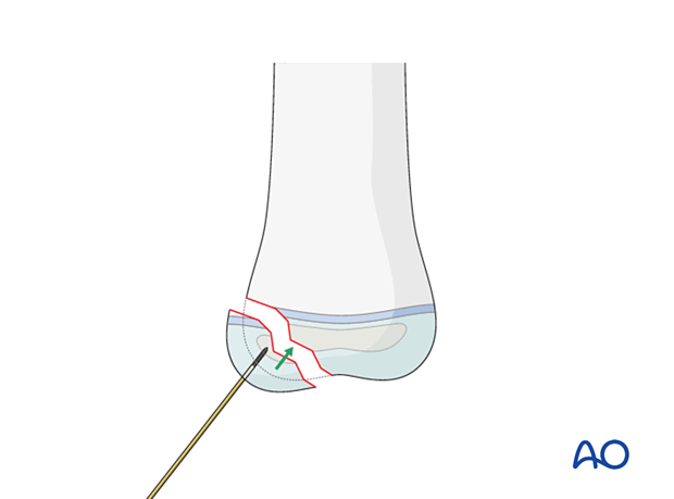 Guide wire as joystick for fragment reduction