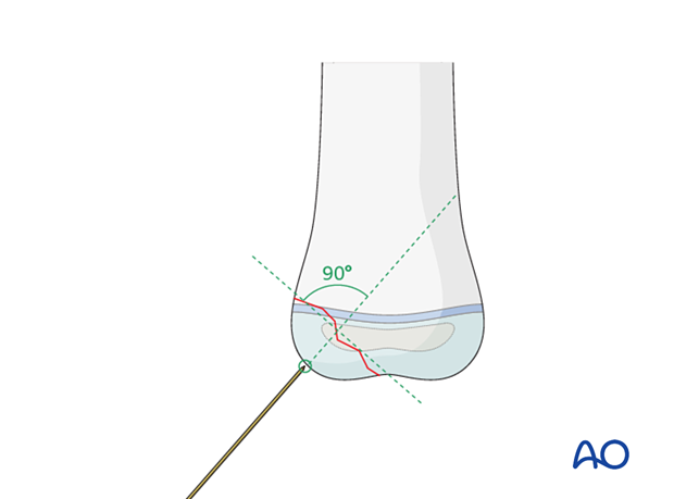 Entry point of guide wire