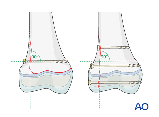 Direction of cannulated lag screw