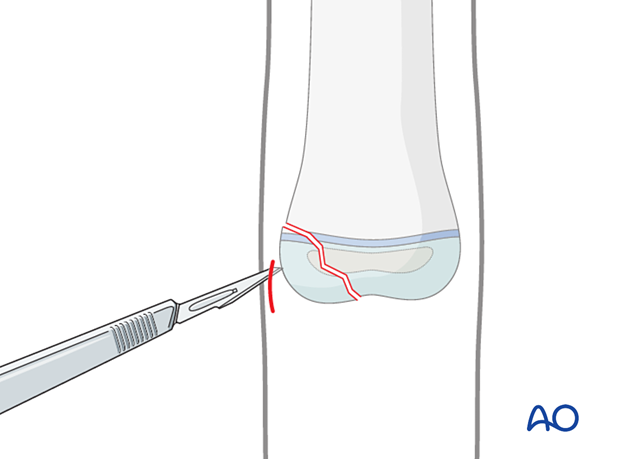 Stab incision