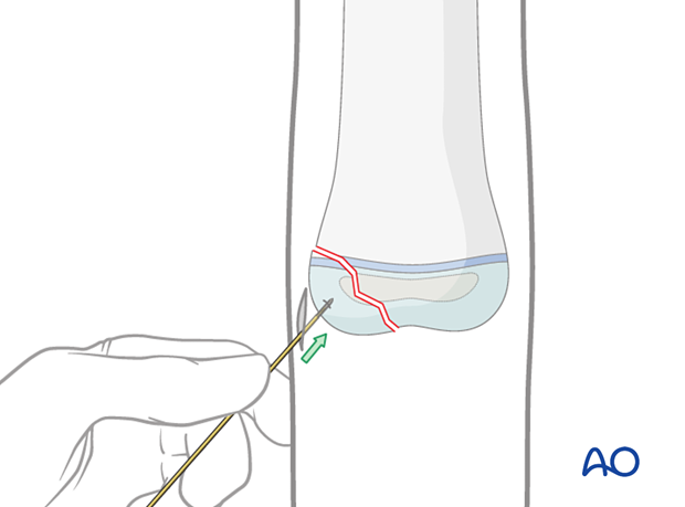 Manual insertion of guide wire