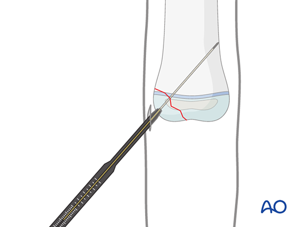 Determining screw length