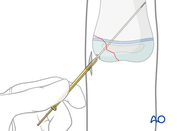 Sliding screw over guide wire